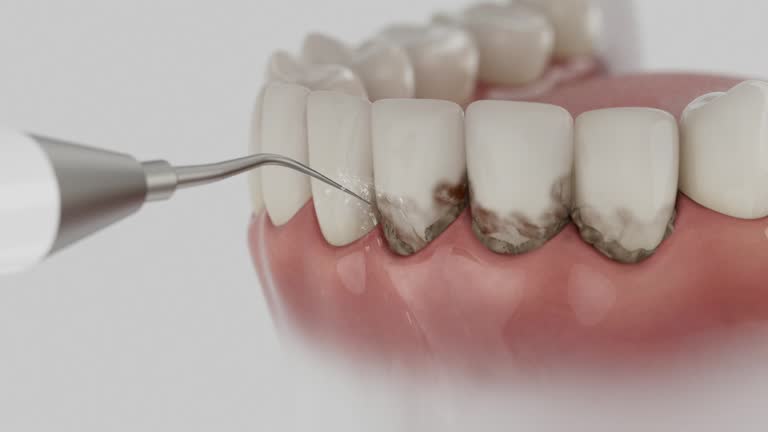 Reliable Dental Implants contractor in Everett, WA by Smile Center Dentistry